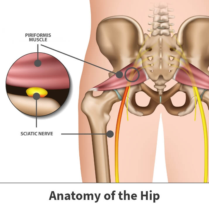 Piriformis Syndrome Florida Orthopaedic Institute