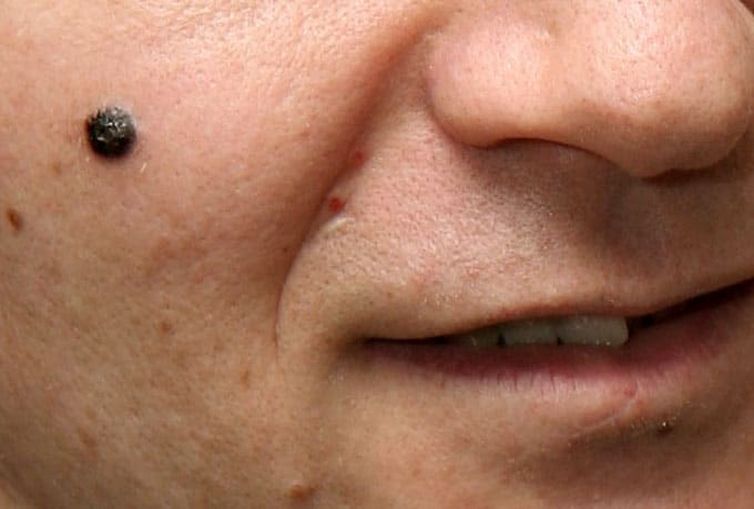 Mole removal Which is the best way? Flux Magazine
