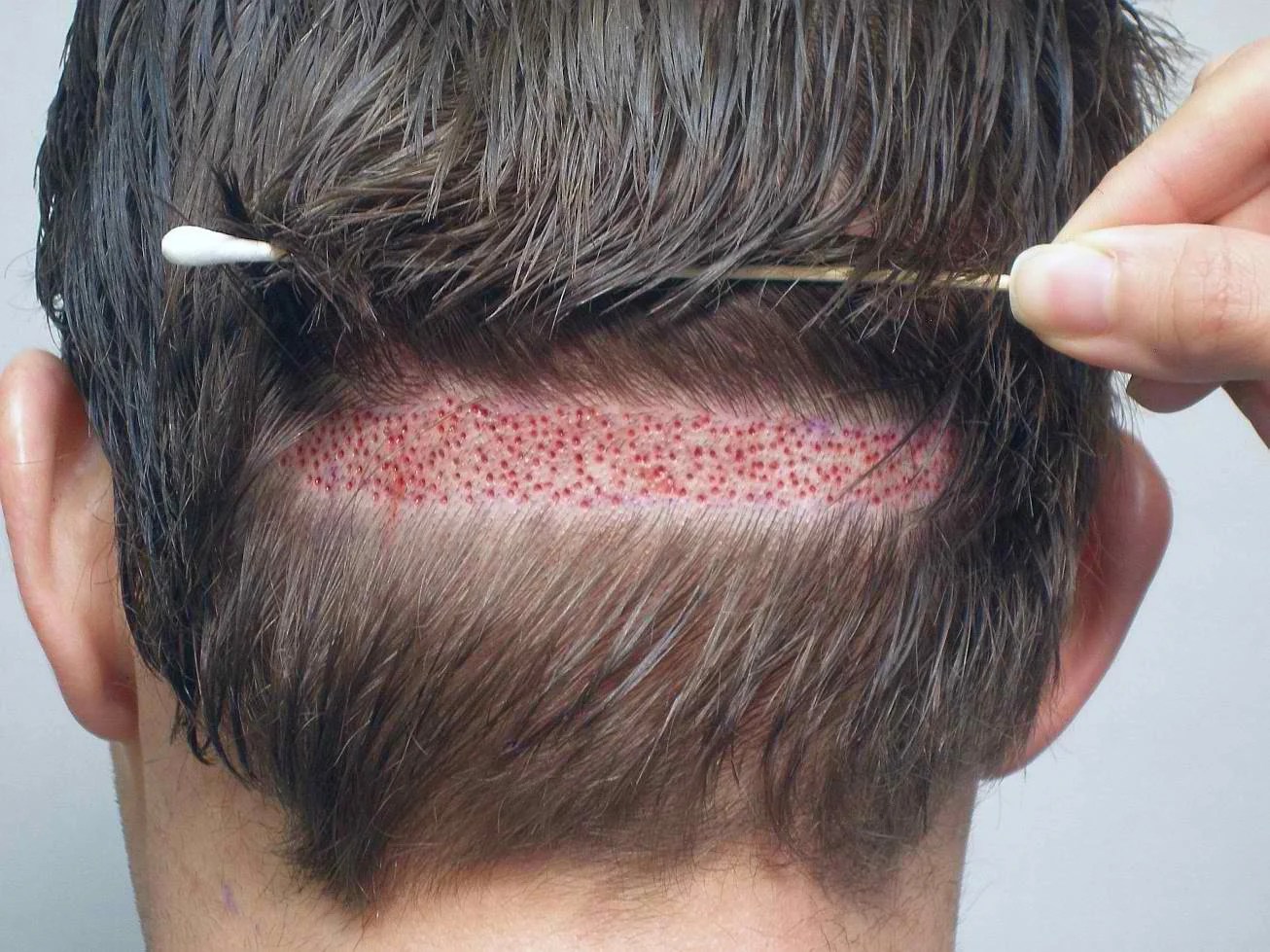 Which Hair Transplantation Method Is the Best For You? Fly to Cure Blog