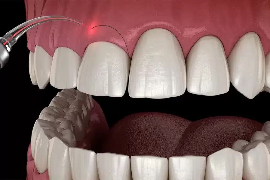 Gingivectomy FMS DENTAL HOSPITAL
