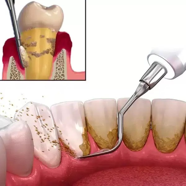 Scaling & Root Planing Treatment in Hyderabad India, FMS Dental