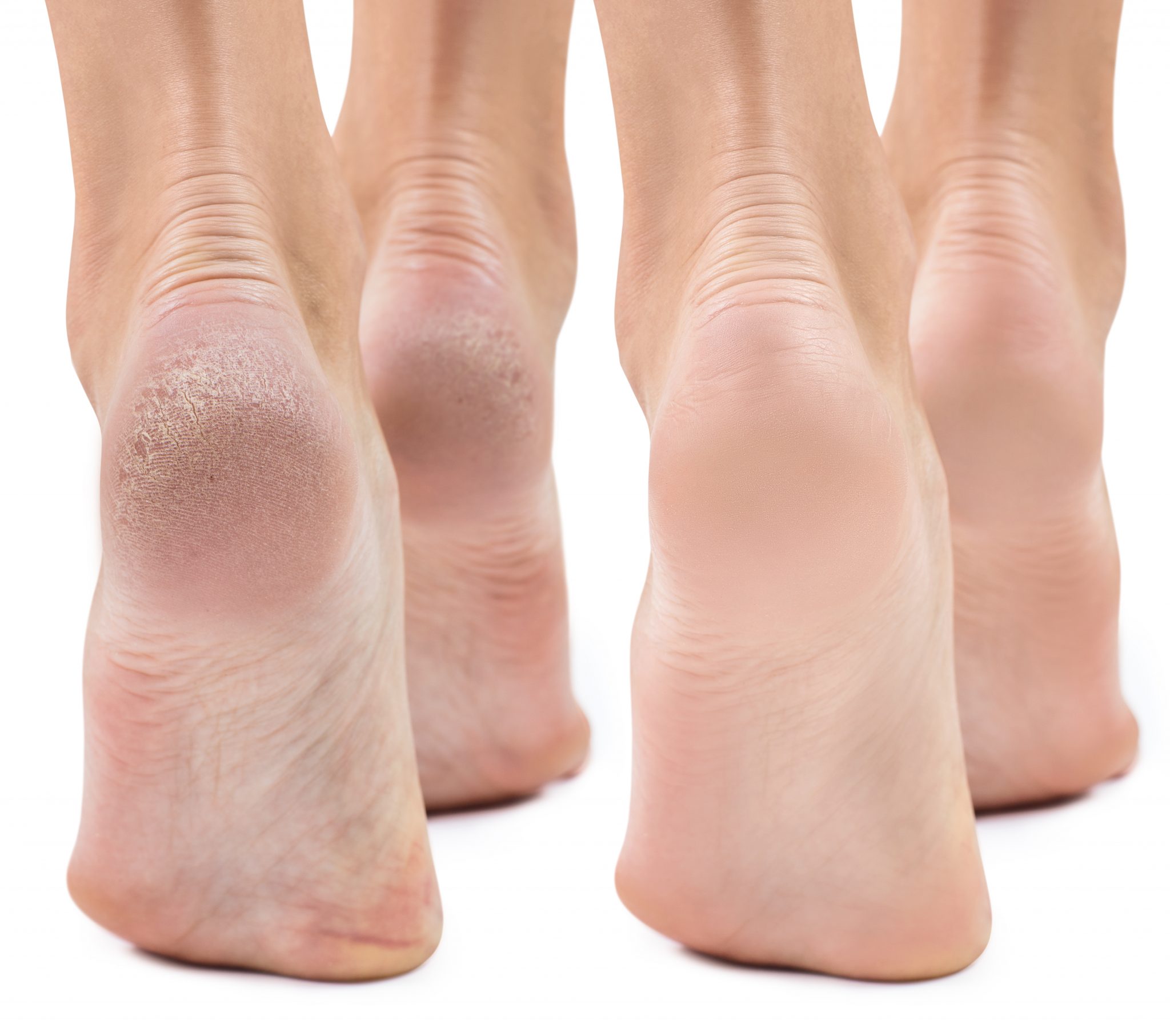 Dry Feet & Cracked Heels Causes & Treatment Foot and Ankle Group
