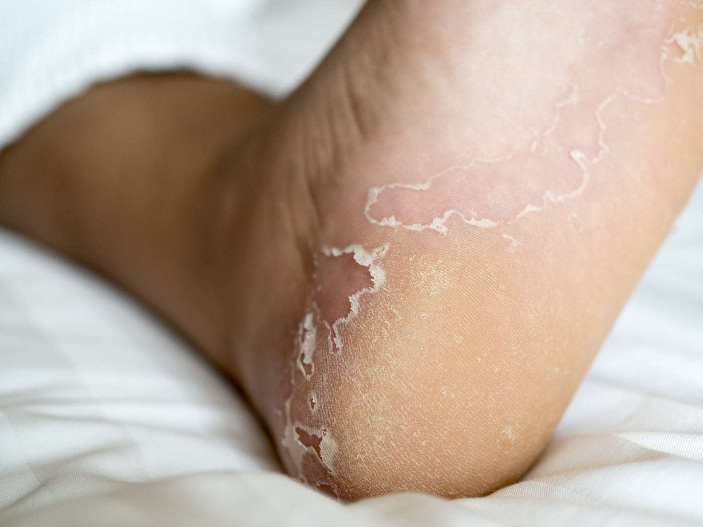 Athlete's Foot Treatment with Essential Oils Foot & Leg Centre