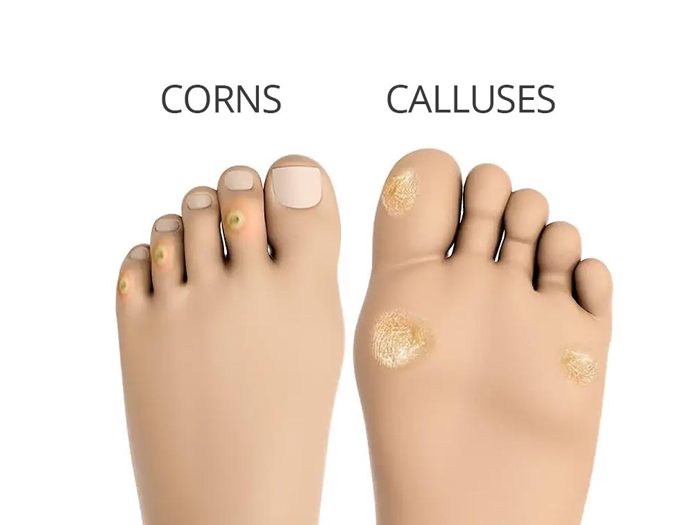 Why Do Corns and Calluses Form?