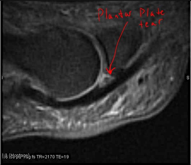 Plantar plate tears part 2 Foot Doctor San Diego / La Jolla Podiatrist