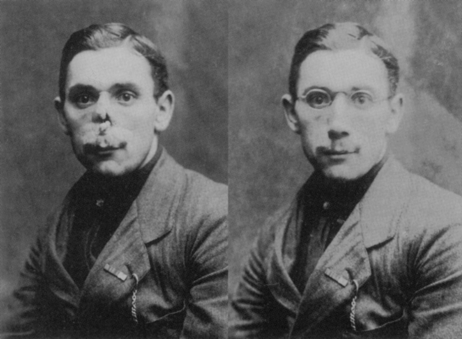 The Boy With Deformed Face Mask