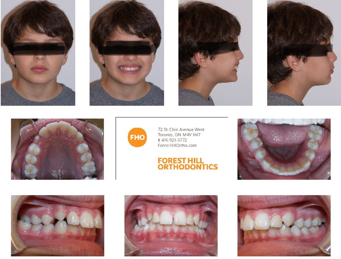 What to Expect at Your First Orthodontic Visit Forest Hill