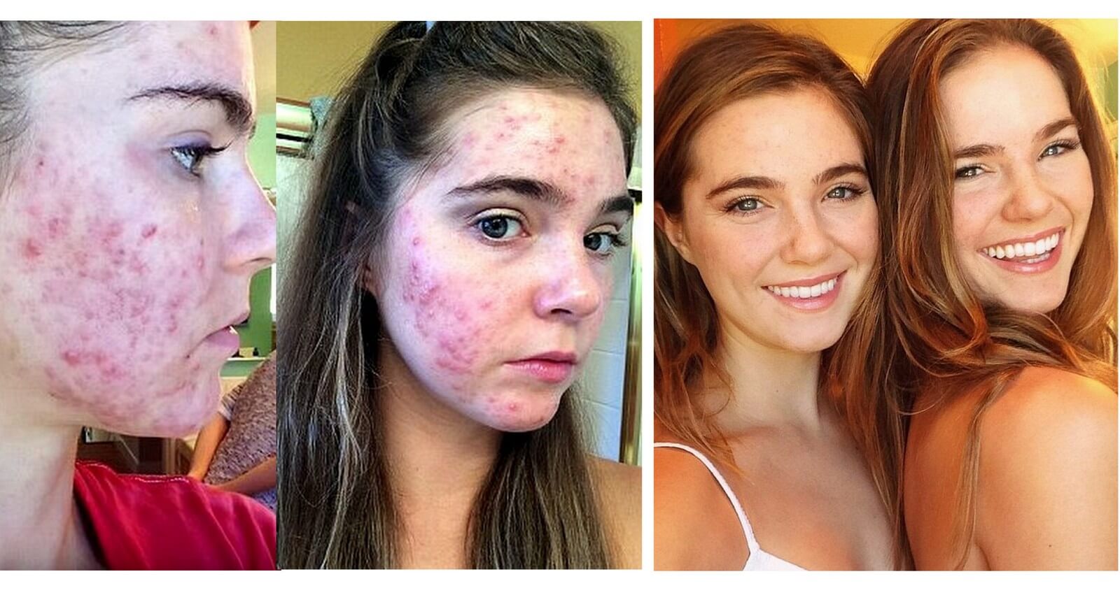 How We Beat Cystic Acne With a Vegan Diet Forks Over Knives