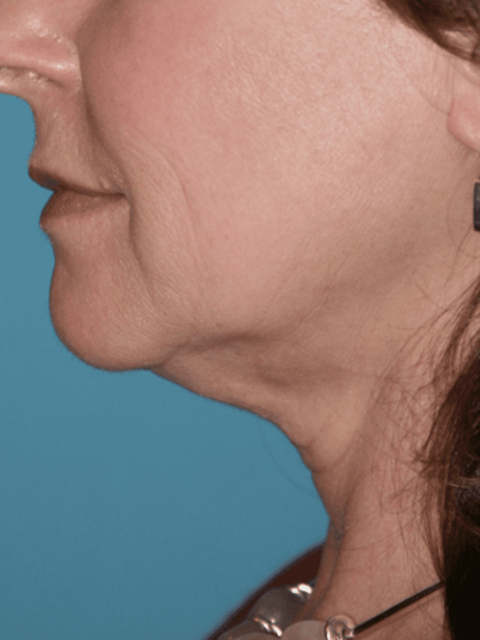 Neck Lift Providence Rhode Island Necklift Dartmouth