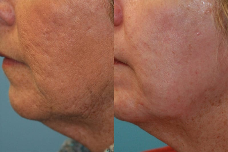 CO2 Laser Resurfacing 01 Fox Facial Plastic Surgery Center
