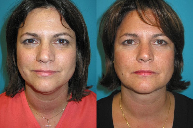 Neck Lift Archives Fox Facial Plastic Surgery Center