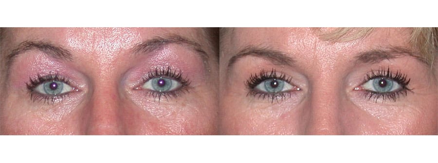 Blepharoplasty 10 Fox Facial Plastic Surgery Center