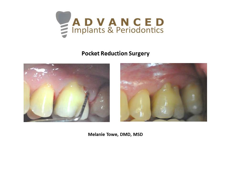 Pocket Reduction Surgery Advanced Implants & Periodontics