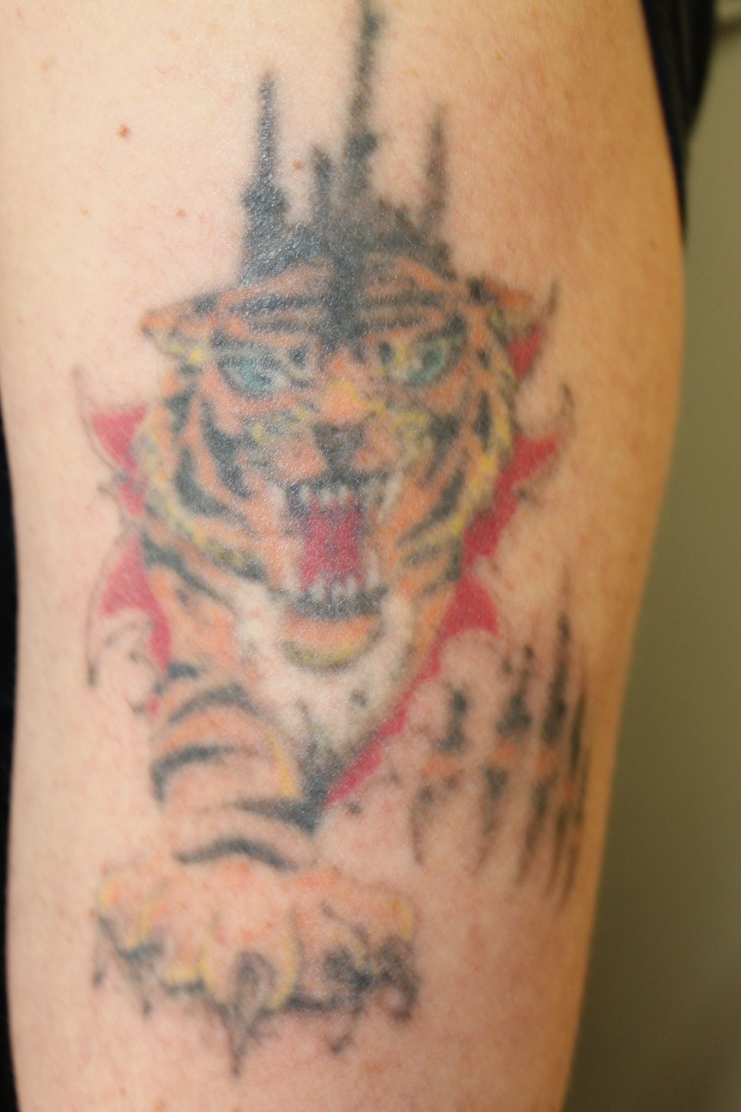 Tattoo Removal Fresh Start Skincare & Laser