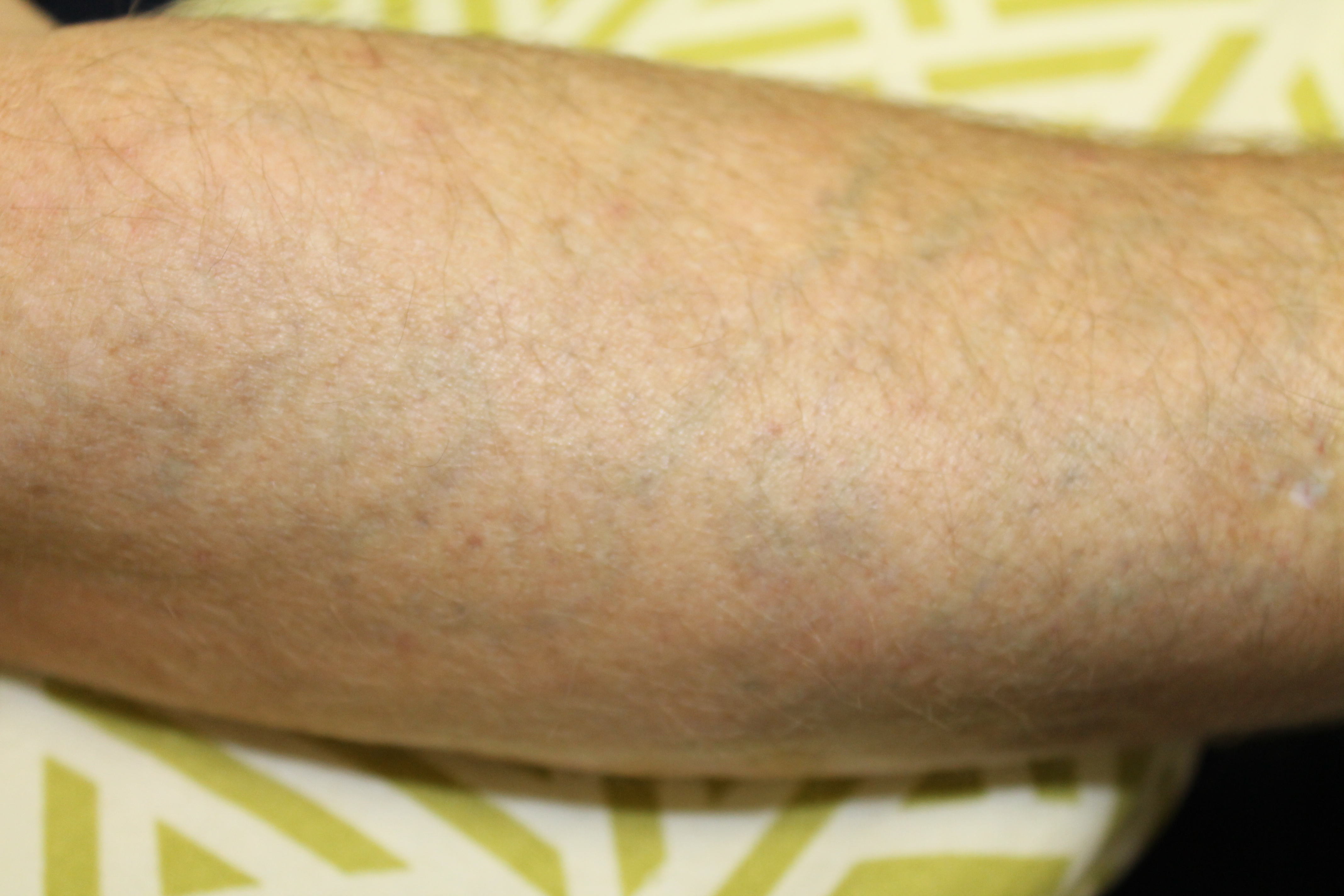 Tattoo Removal Fresh Start Skincare & Laser