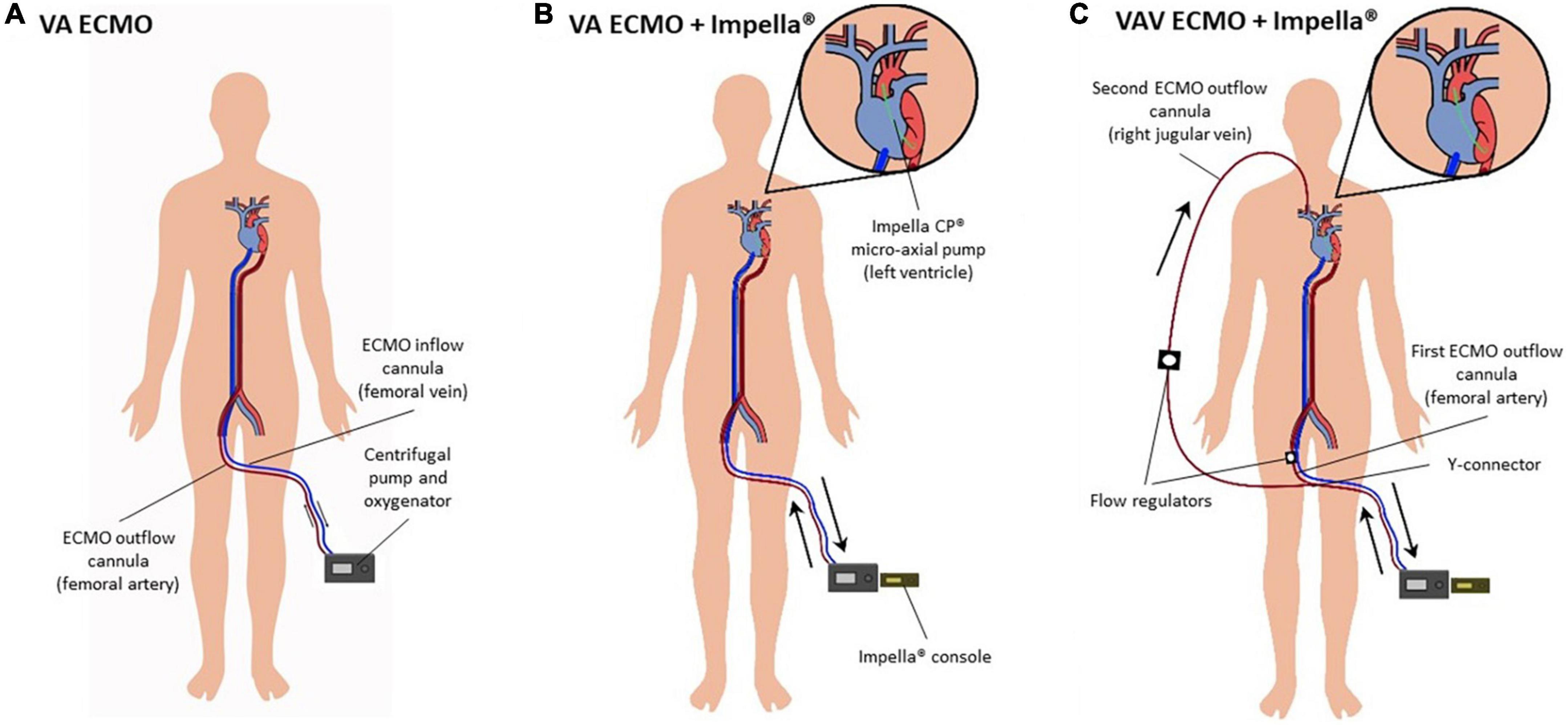 Frontiers Case report Refractory cardiac arrest supported with veno