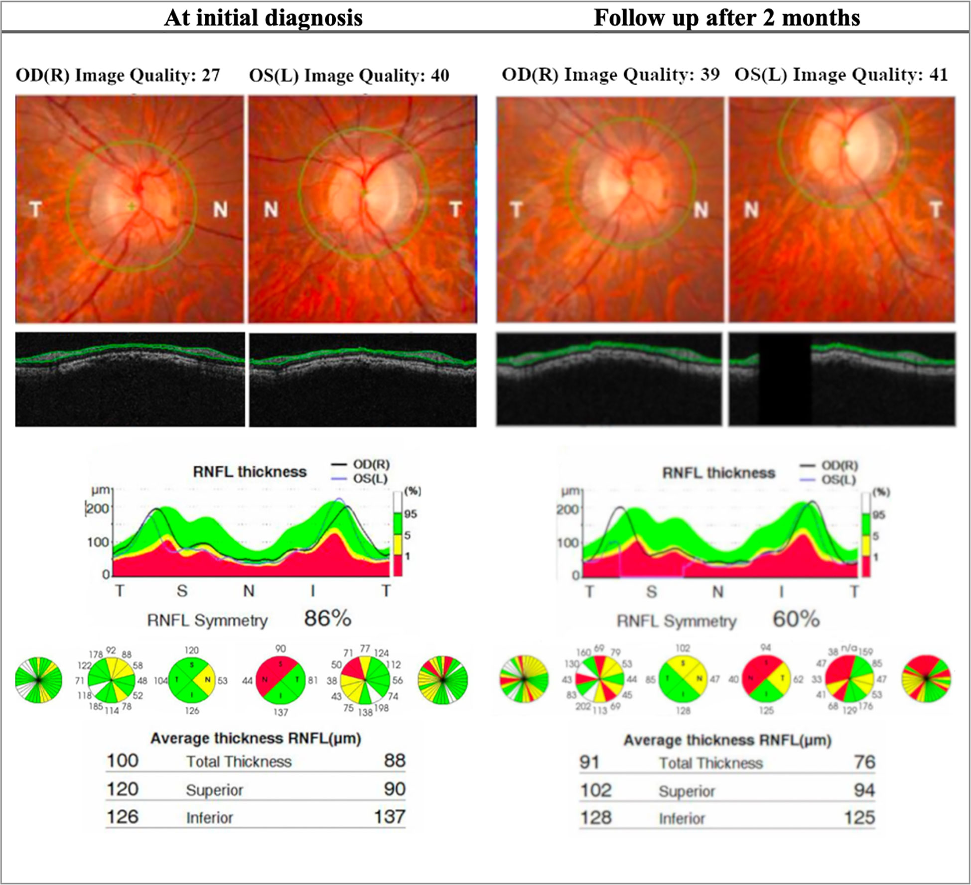 Frontiers Leber’s hereditary optic neuropathy Update on current