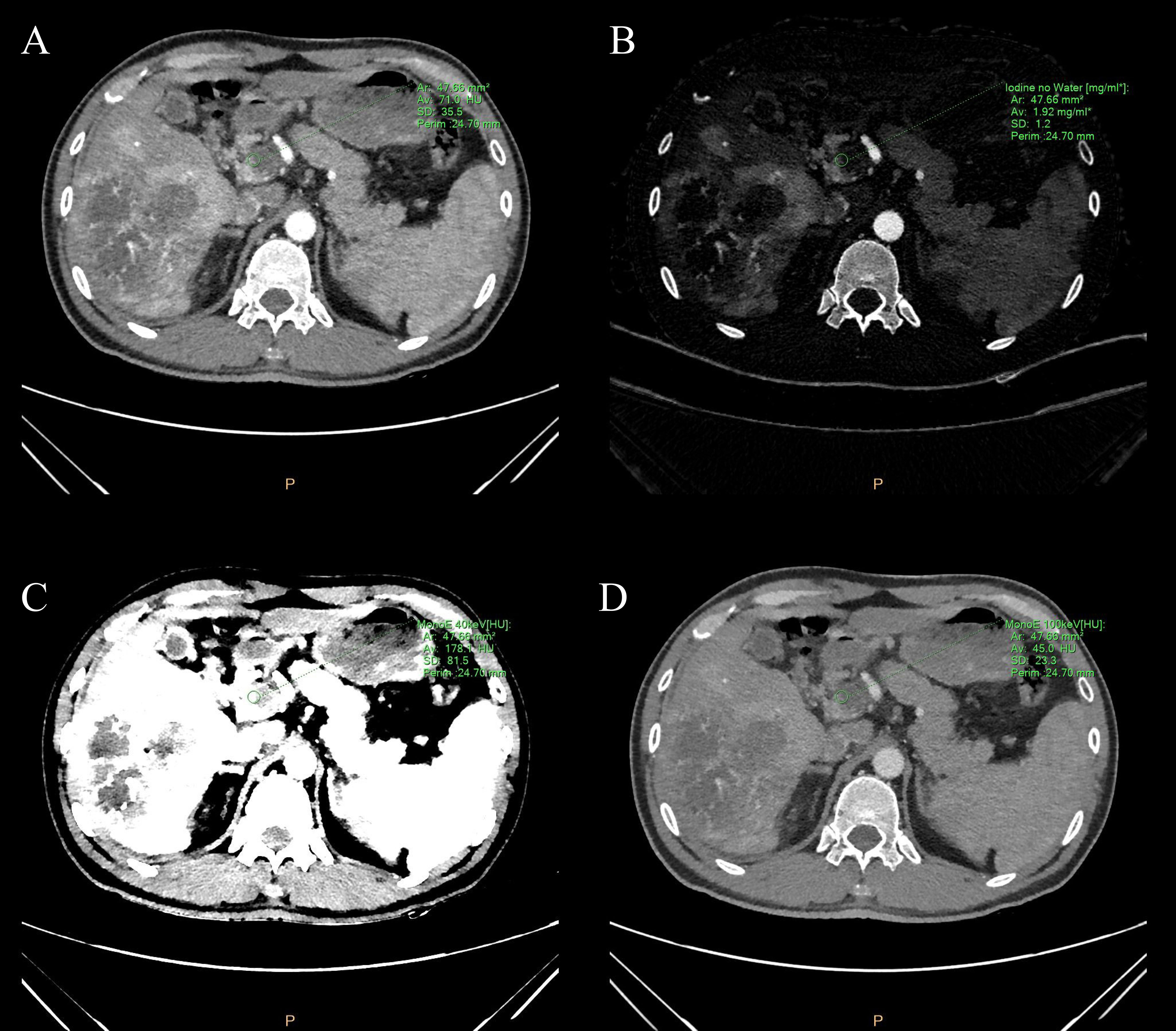 Frontiers Clinical application of spectral CT perfusion scanning in