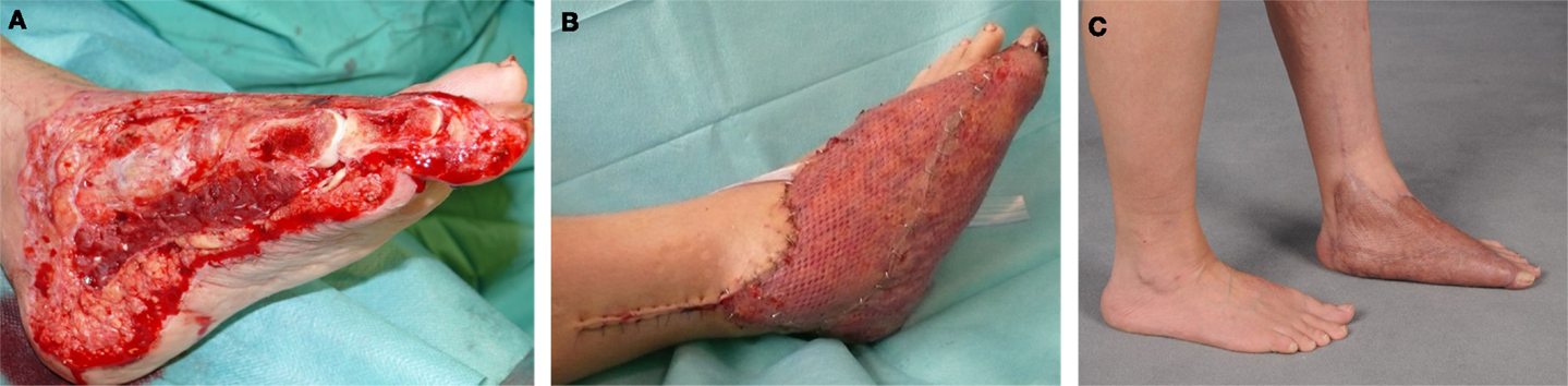 Frontiers Reconstruction of SoftTissue Defects at the