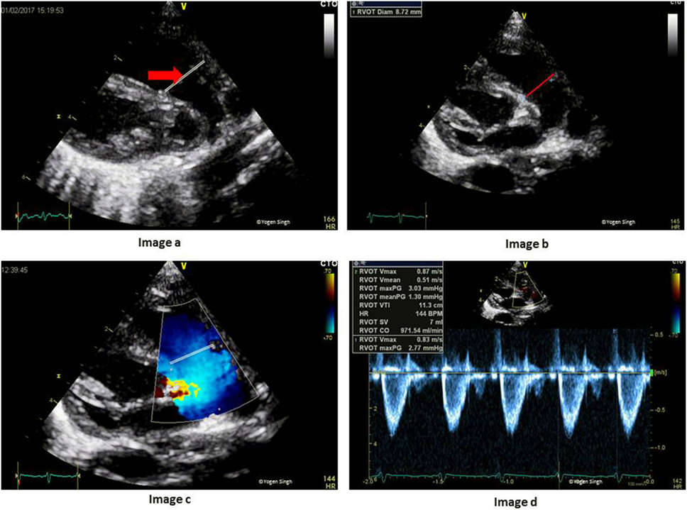 Frontiers Echocardiographic Evaluation of Hemodynamics in Neonates