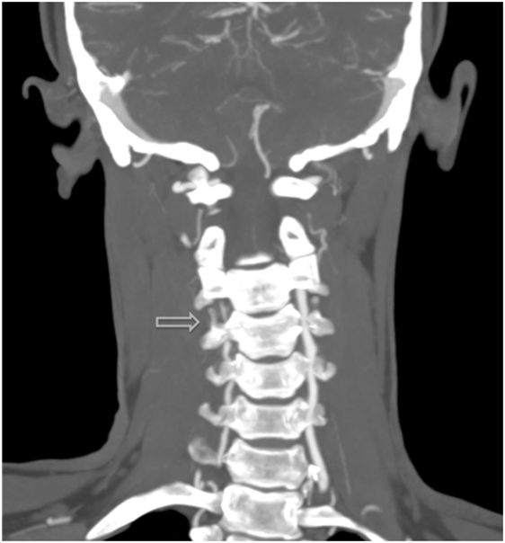 Frontiers LenvatinibAssociated Cervical Artery Dissections in a