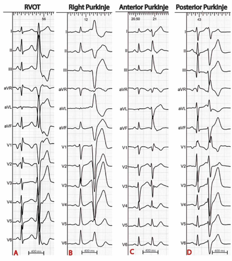 Frontiers Mapping and Ablation of Idiopathic Ventricular Fibrillation