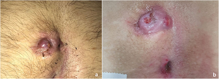Frontiers Pediatric Endoscopic Pilonidal Sinus Treatment (PEPSiT) in