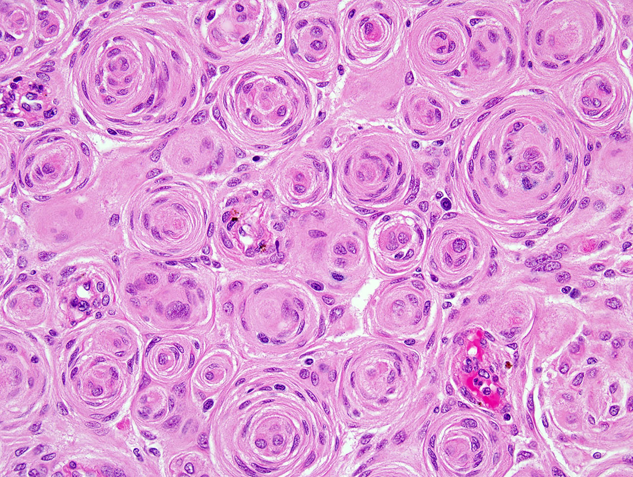 Frontiers Meningioma A Review of Clinicopathological and Molecular