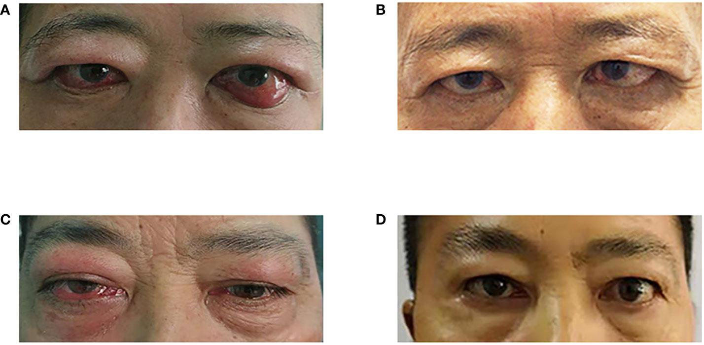Frontiers Use of Rituximab After Orbital Surgery in Two