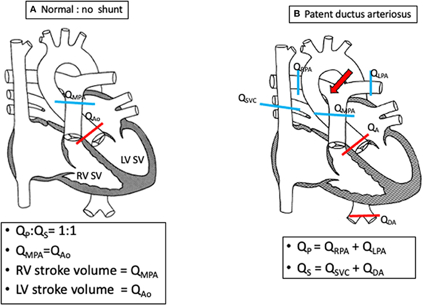 Frontiers Noninvasive Imaging in the Evaluation of Cardiac Shunts