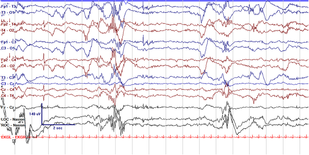 Frontiers Current and Future Uses of Continuous EEG in the NICU