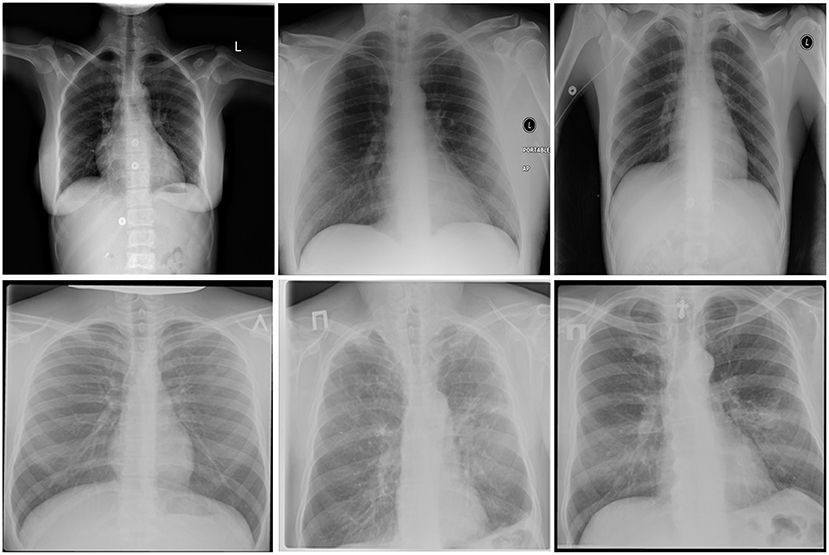 Chest X Ray Tb Vs Normal