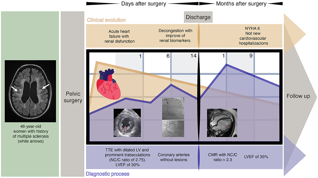 Multiple Sclerosis Effect On Heart
