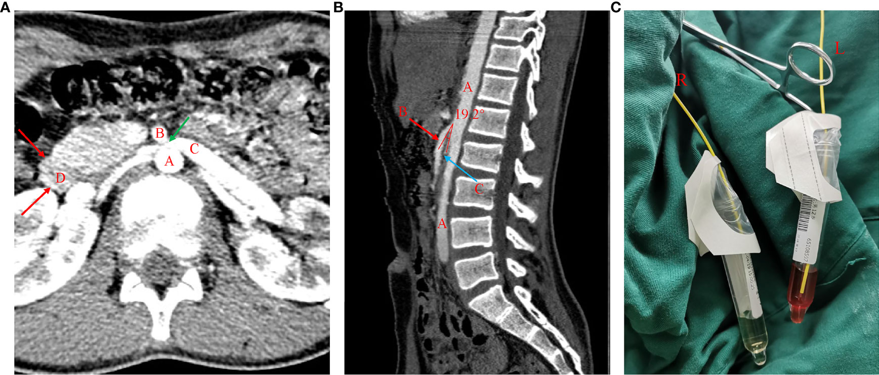 Frontiers Case Report An Unusual Case of Nutcracker Syndrome and