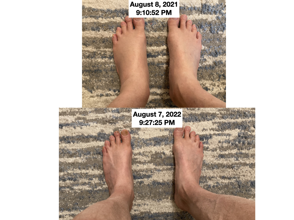 How I Fixed Foot Swelling (Lower Limb Edema)