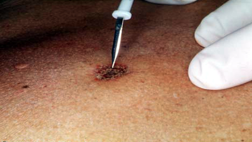 HPV Signs and Symptoms