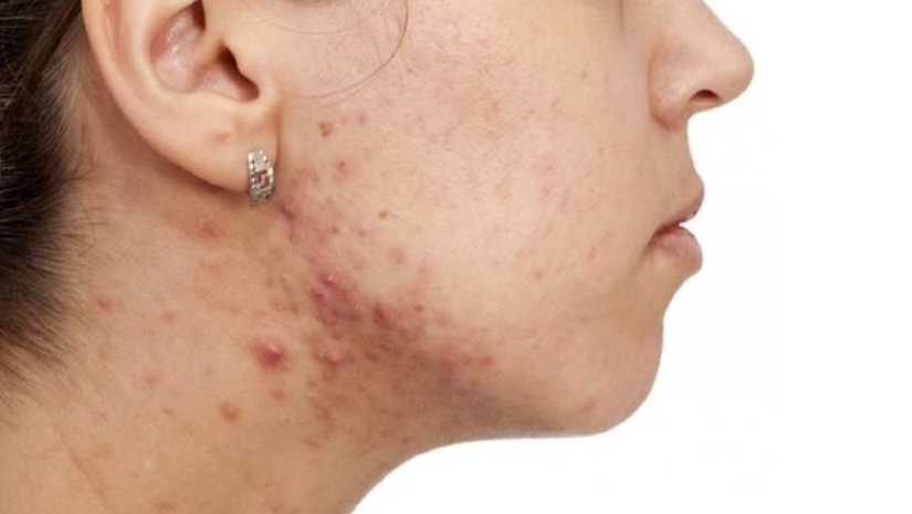 Acne and Health
