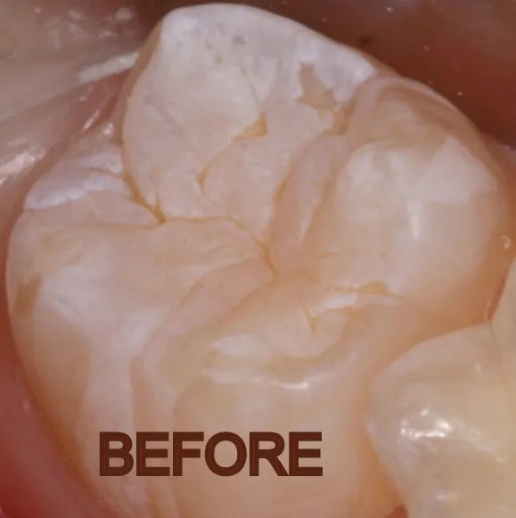 Pediatric Dentist — Dental Sealant — Fluoride — Preventive Care