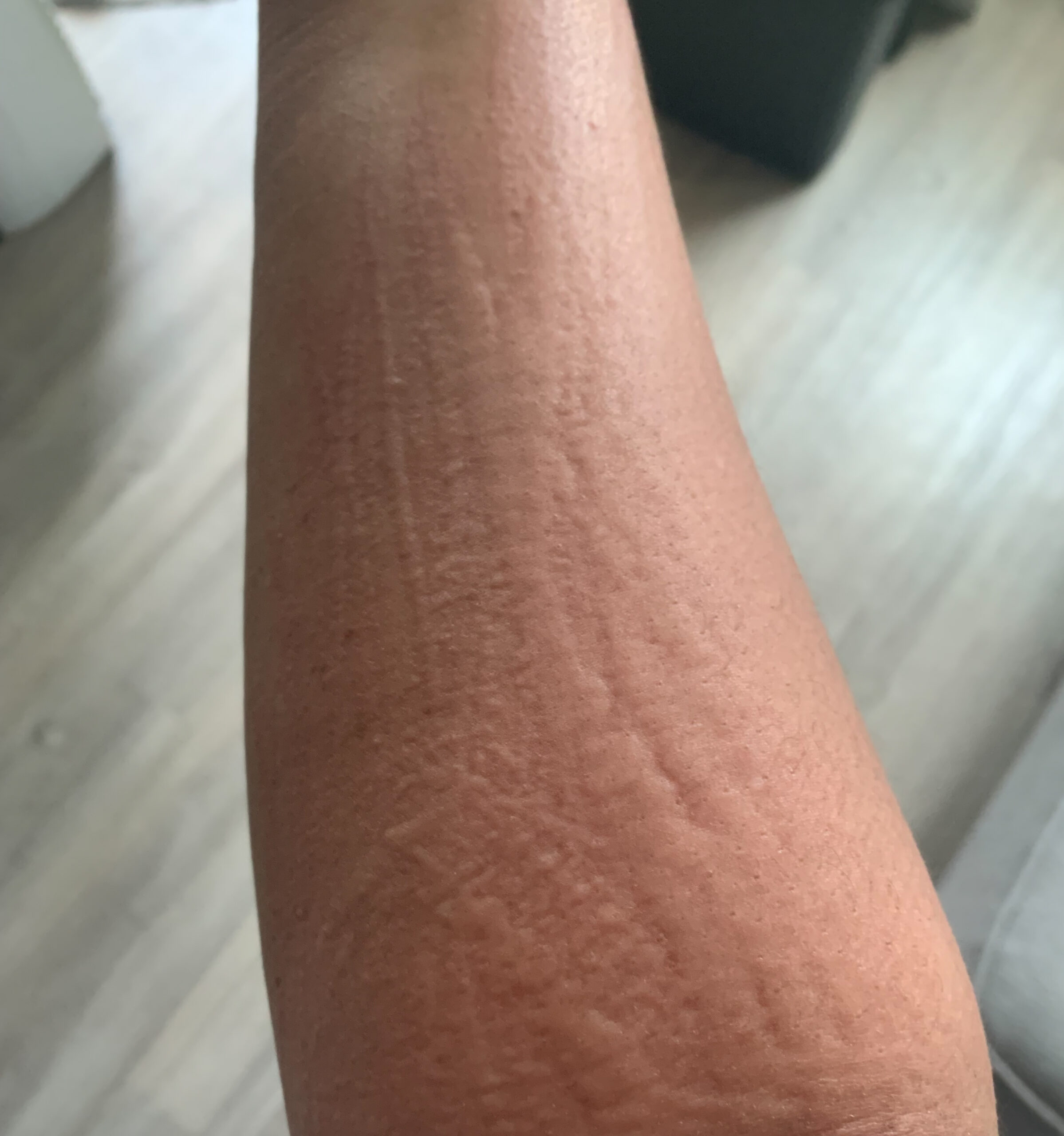 What Causes Histamine Intolerance? Fussy Mug