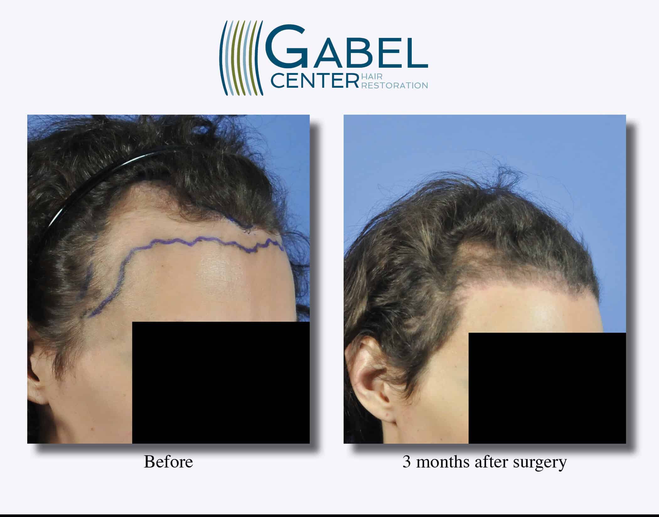 Watch a Patient’s RealTime Growth after 3439 Grafts Gabel Center