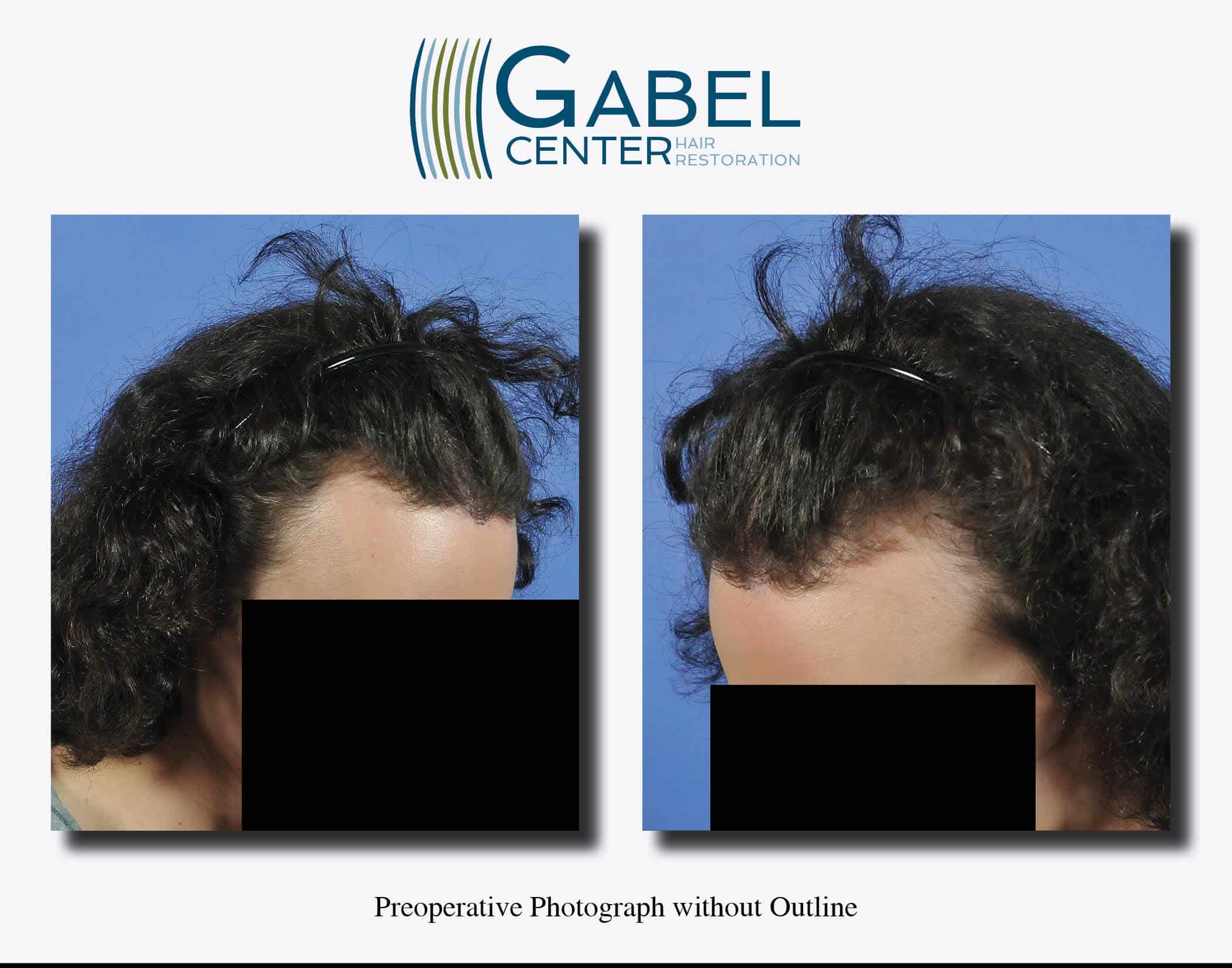 Watch a Patient's RealTime Growth after 3439 Grafts Gabel Hair