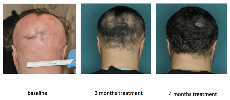 Nuove speranze per l'alopecia areata Galileo
