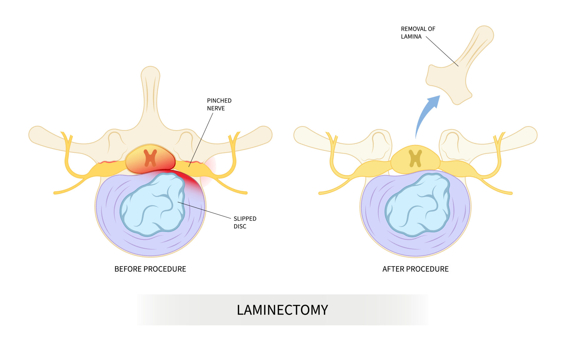 Laminectomy & Discectomy What Are the Differences
