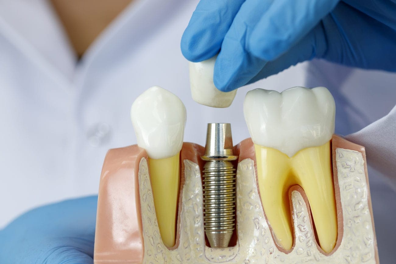 Dental Implants in Garner NC Tooth Replacement Options