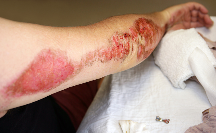 Severe Road Rash Law Offices of Gary Martin Hays & Associates, P.C.