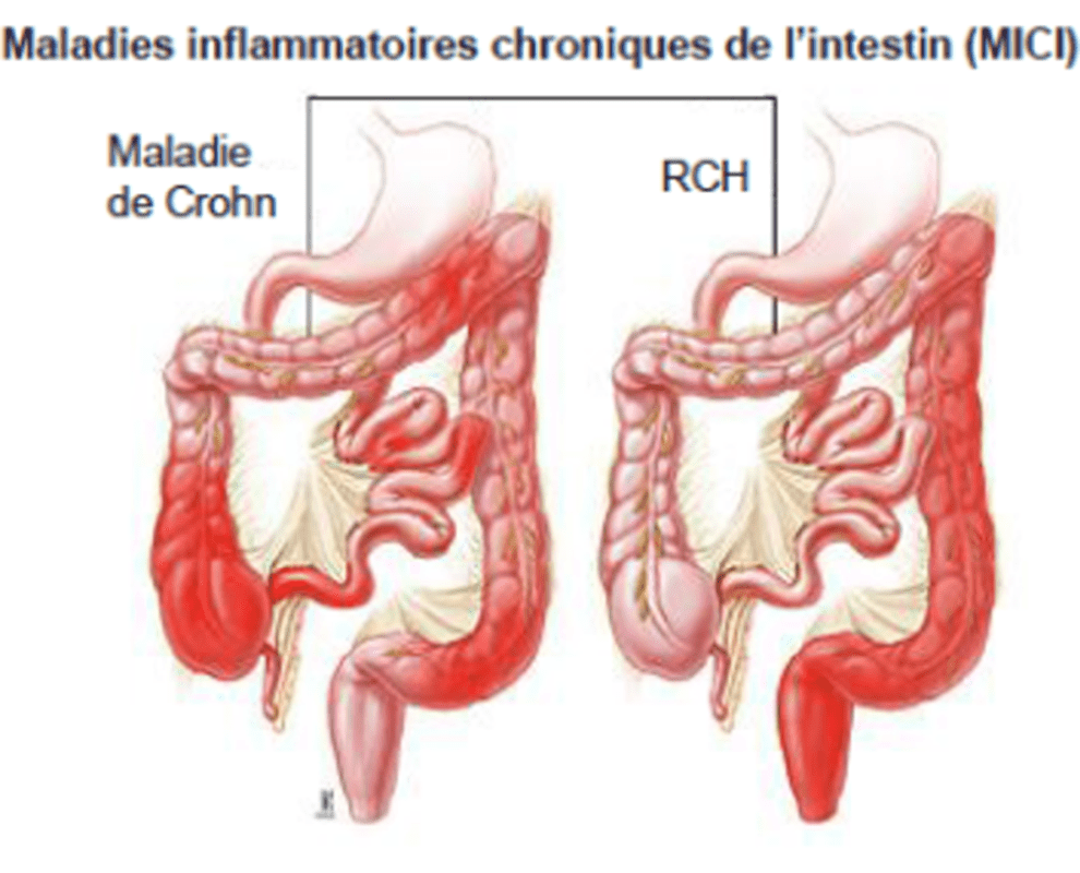 Maladies inflammatoires chroniques de l’intestin Gastroentérologue