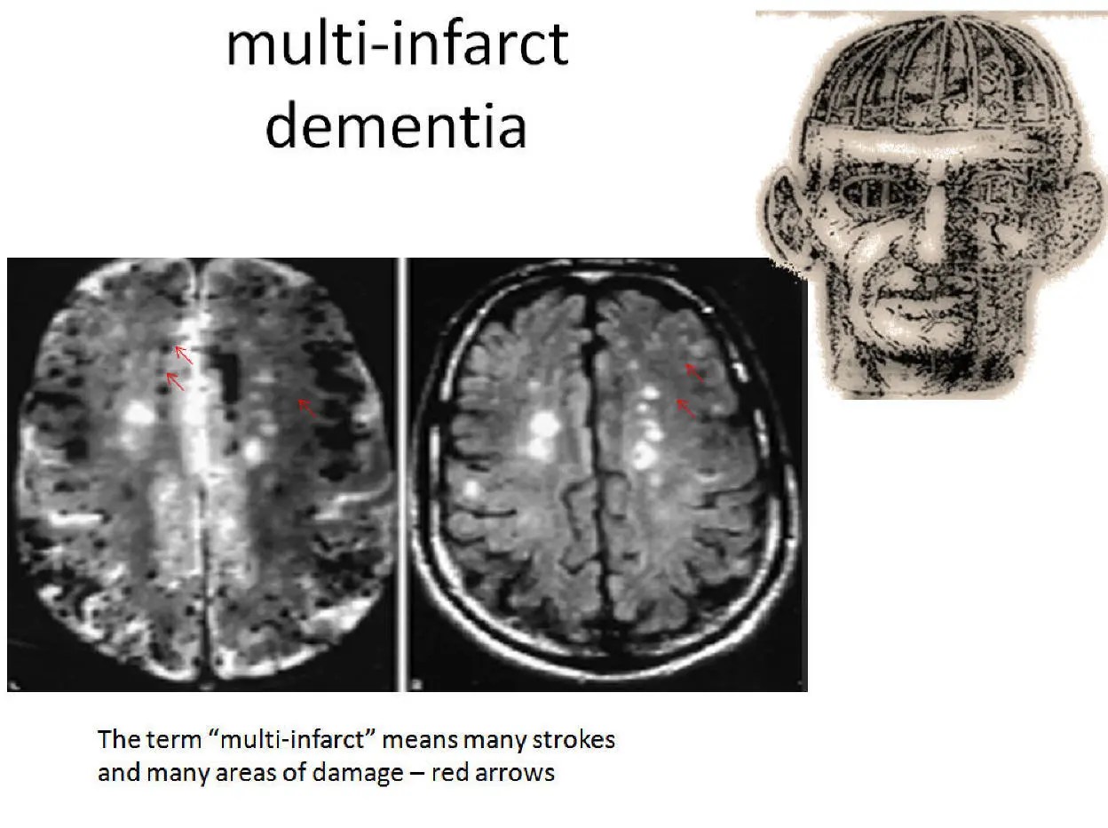 Multi Infarct Dementia Life Expectancy