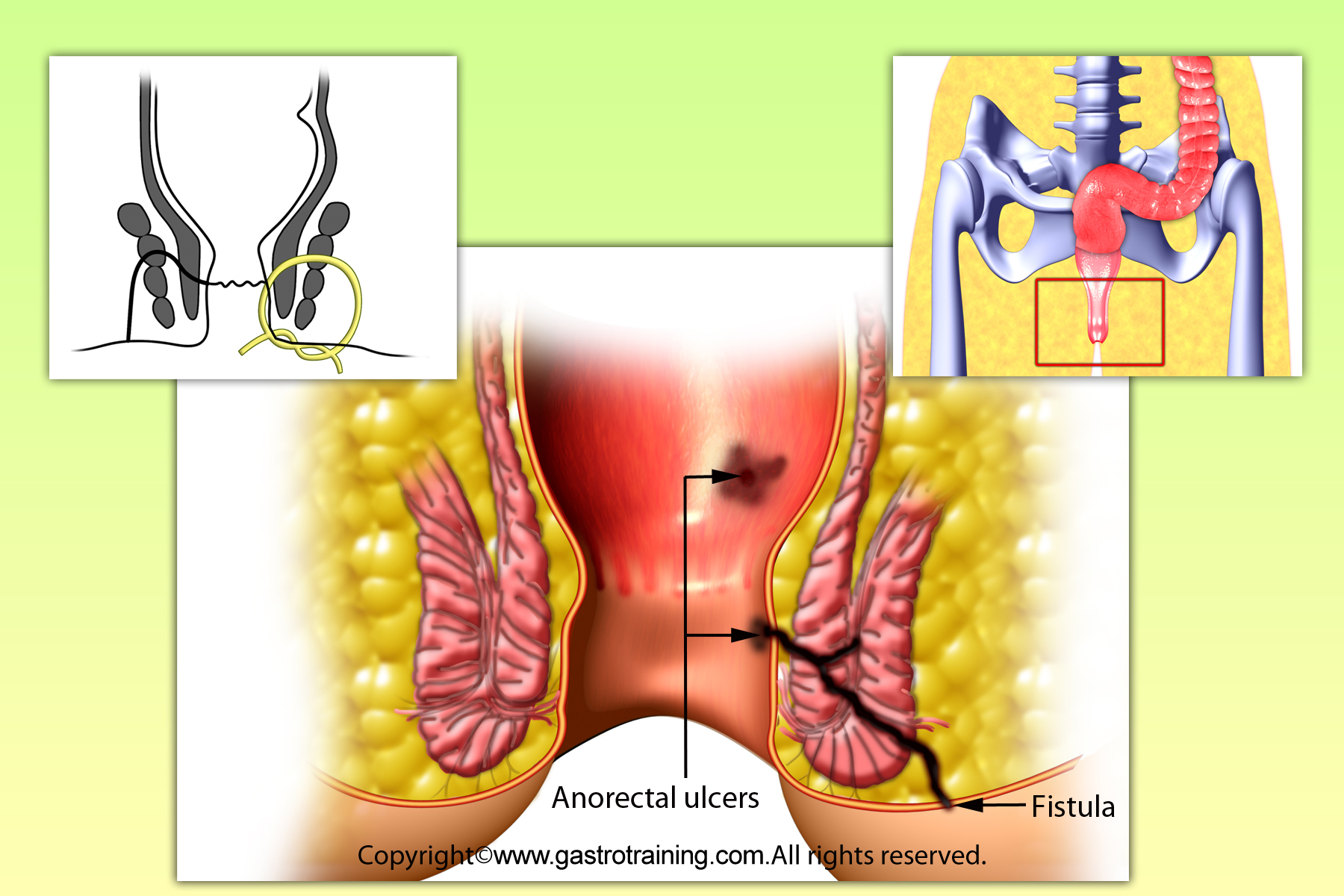 Gastroenterology Education and CPD for trainees and specialists » Setons