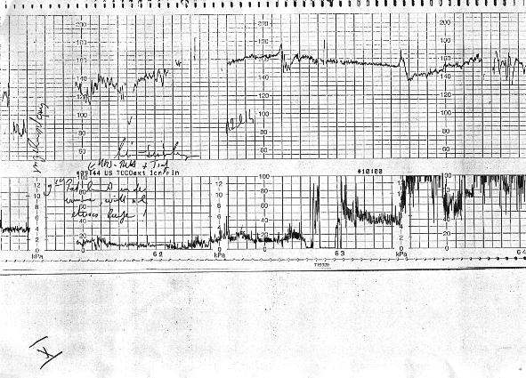 CTG = CardioTokograph, Der Herzton und Wehenschreiber. Soll ein "schlechtes" CTG toleriert