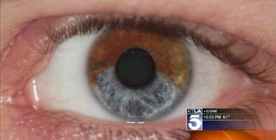 Laser Surgery That Can Permanently Change Eye Color The Mary Sue